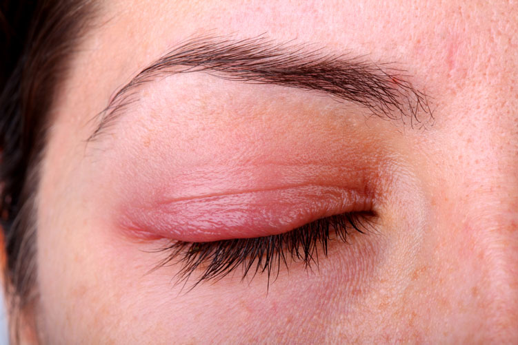 eyelid diseases